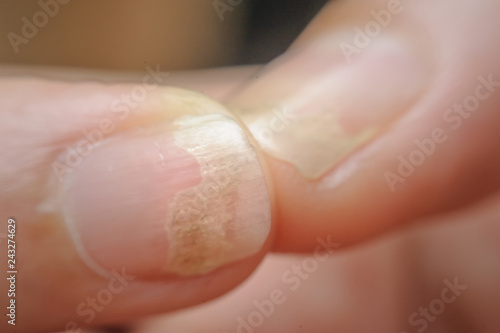 Onychomycosis or Fungal nail infection on thumb and forefinger