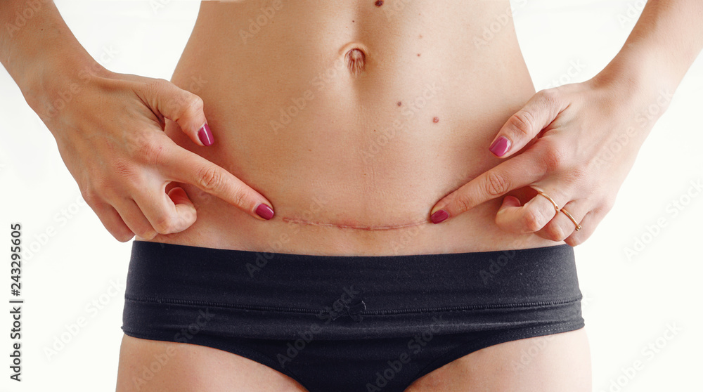 Closeup of woman belly with a scar from a cesarean section Closeup of woman belly with a scar from a cesarean section