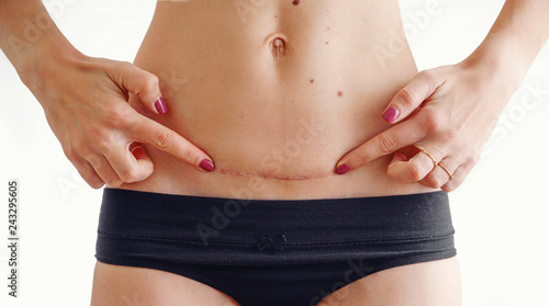 Obraz na plátně Closeup of woman belly with a scar from a cesarean section