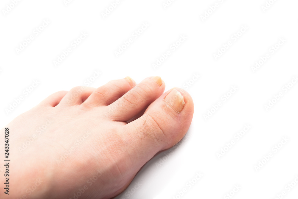Damaged toenail isolated on white background. Toenail fungus Damaged toenail isolated on white background. Toenail fungus