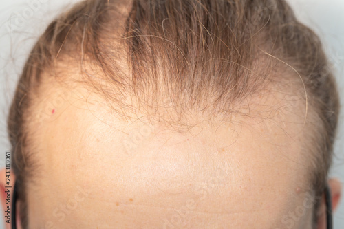 Receding hairline of a young caucasian man