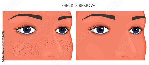 Vector illustration. Freckle removal on woman face (half turn) before, after cosmetic procedure. Close up view. For advertising of whitening medicinal, pharmacy products, cream, lotion