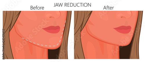 Vector illustration. A young white female face before and after plastic surgery - jaw reduction. Close up view. For advertising of plastic surgery, medical and beauty publications