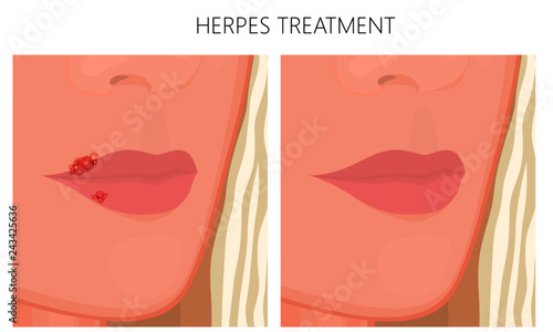 Vector illustration. Herpes on the lips and healthy lips after treatment. Close-up and macro view. To advertise pharmacy products, creams and for medical publications