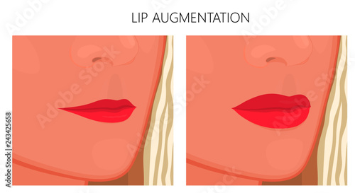 Vector illustration. Lips augmentation on women face in half turn before, after procedure. Close up view. For advertising of medicinal, pharmacy products, cream, lotion, cosmetic procedures