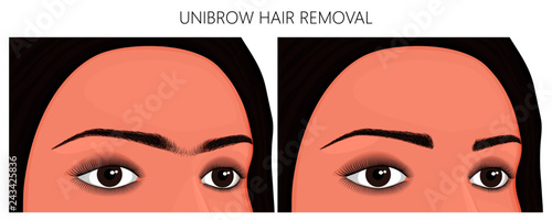 Vector illustration. Unibrow on woman's face before, after excess hair remove. Close up view. For advertising and beauty publications