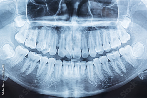 panoramic dental x-ray of a mouth left and right side. photo