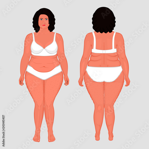 Vector illustration. Front, back views of naked European woman in full growth in underwear. For advertising of cosmetic plastic procedures, stomach shunting, bypass, diet, medical publications