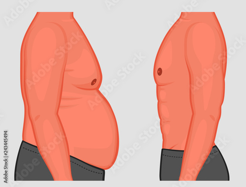 Vector illustration a male before and after weight loss and sports. Side view. For medical publications and advertising of cosmetic, plastic procedures, stomach shunting, diet, sport