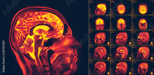 Magnetic resonance imaging of the brain. MRI scan