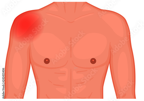Vector illustration of a human shoulder joint with a pain or injury. Front view. For advertising, medical publications