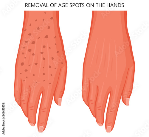 Vector illustration of a human hand with age spots before and after removal. Dorsal view. For advertising, medical publications