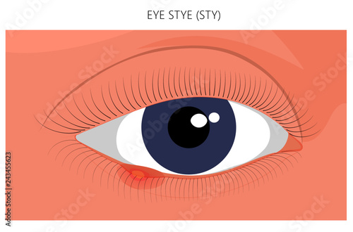 Vector illustration. Eye Stye (Sty) problem. Close up view. For advertising, medicinal publications