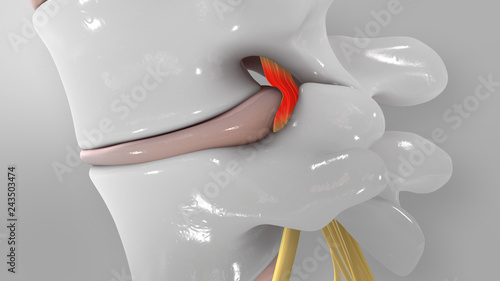 Herniated Disc 3D Illustration
