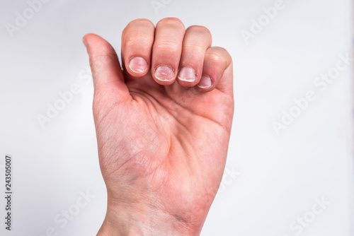 фотографія Fingers with badly or chewed bitten nails on gray background.