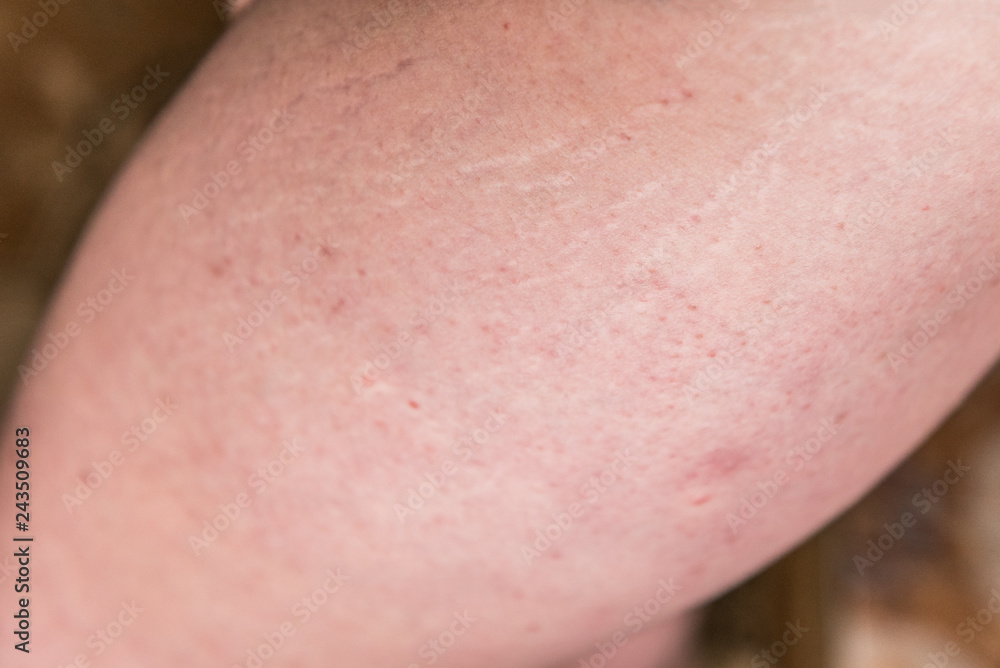 Women fat hips with stretch marks. Women fat hips with stretch marks.