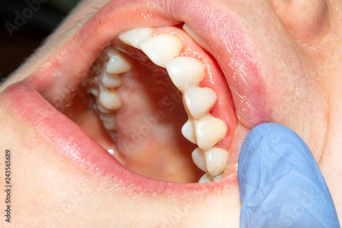 two chewing side teeth of the upper jaw after treatment of caries. Restoration of the chewing surface with a photopolymer filling material using the Rubber Dam system