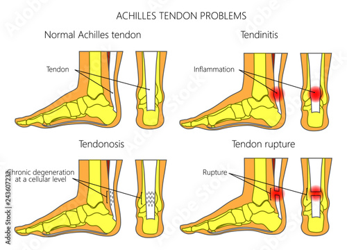 Illustration of Skeletal ankles (side view and back view) with normal and injured  Achilles tendon (tendinitis, tendinosis and torn) photo