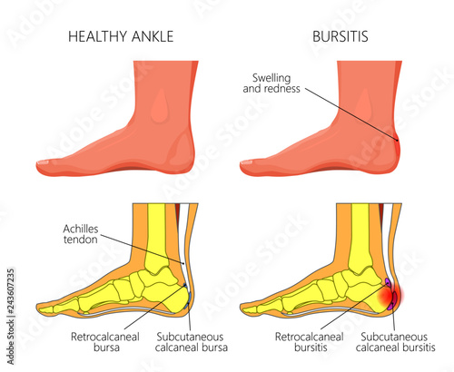 Illustration of Skeletal ankle (side view) with Retrocalcaneal and Subcutaneous calcaneal bursitis. Used: Gradient, blend, transparency, blend mode. photo