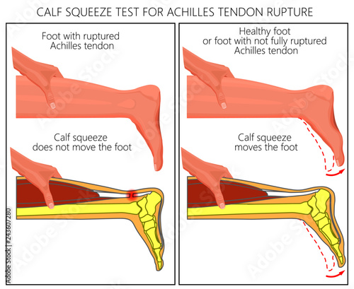 Illustration of a calf squeeze test Achilles tendon rupture. External and Skeletal view of an ankle