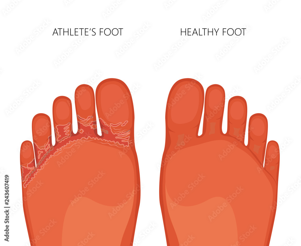 Illustration of Athlete's foot or tinea pedis (soles of the feet) with damaged skin between and under the toes. For medical publications Illustration of Athlete's foot or tinea pedis (soles of the feet) with damaged skin between and under the toes. For medical publications