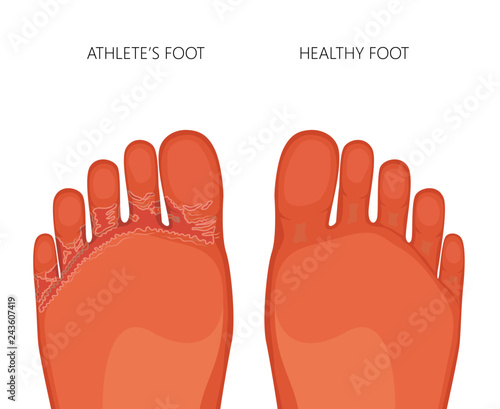 Illustration of Athlete's foot or tinea pedis (soles of the feet) with damaged skin between and under the toes. For medical publications