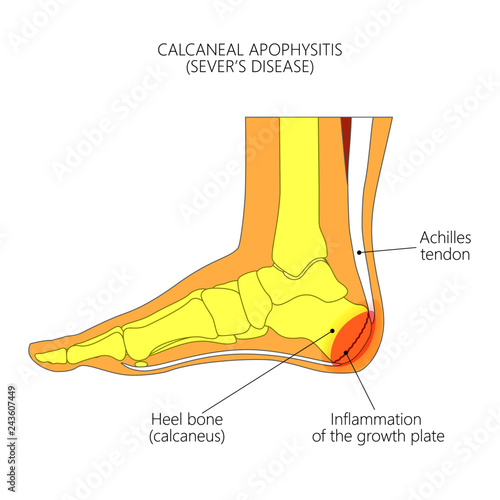 Illustration of an ankle (side view) with children's disease Calcaneal Apophysitis, inflammation of the growth plate of the heel photo