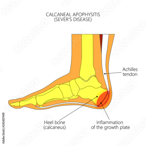 Illustration of an ankle (side view) with children's disease Calcaneal Apophysitis, inflammation of the growth plate of the heel