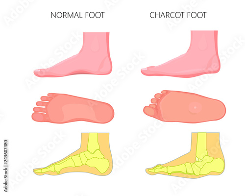 Illustration of normal and rocker bottom Charcot foot (soles of the feet and medial view shows deformity of the foot).