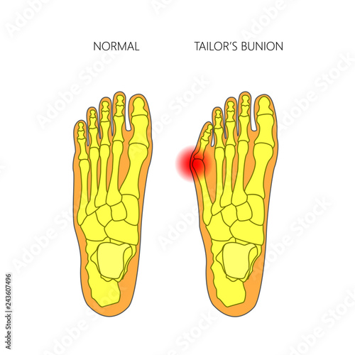 Vector illustration of the tailor's bunion. Used: gradient, transparency; blend mode.