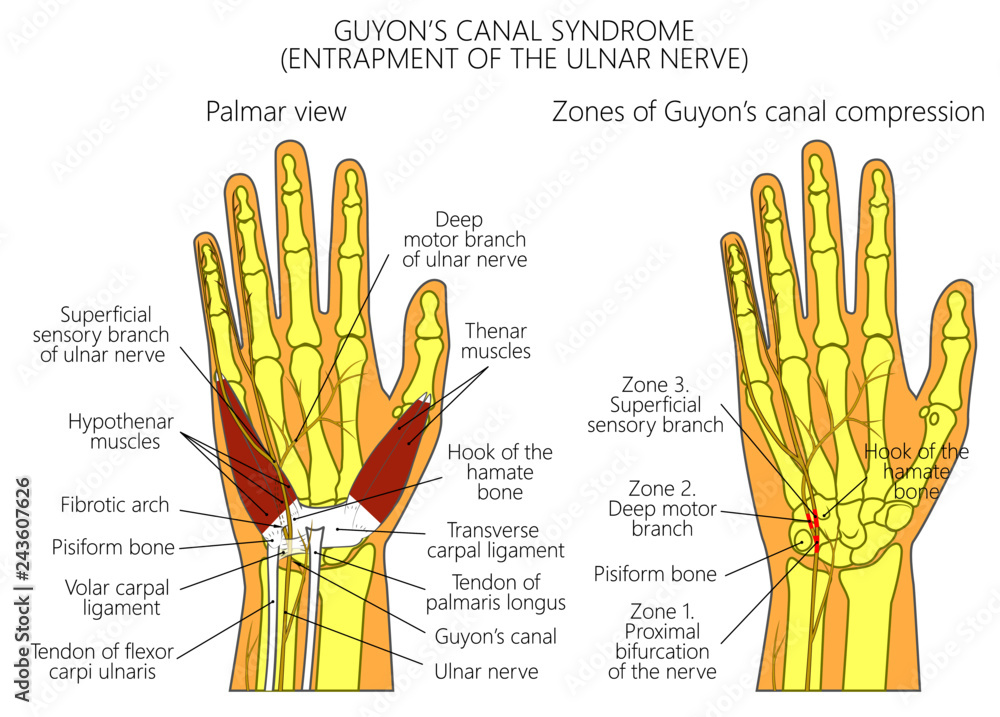 Figure 2 From Ulnar Nerve Entrapment In Guyon S Canal vrogue.co
