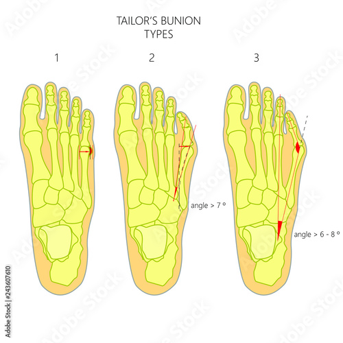 Diagnosis of the tailor's bunion with angles of deviation.