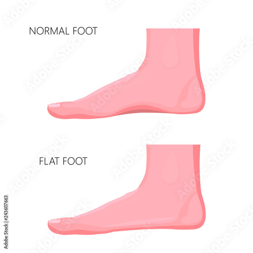 Realistic illustration of a normal foot and a flat foot.