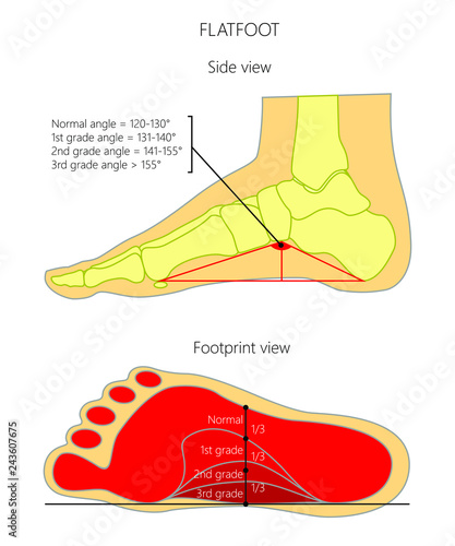 Illustration of flatfoot grade. Side view and bottom view (footprint).