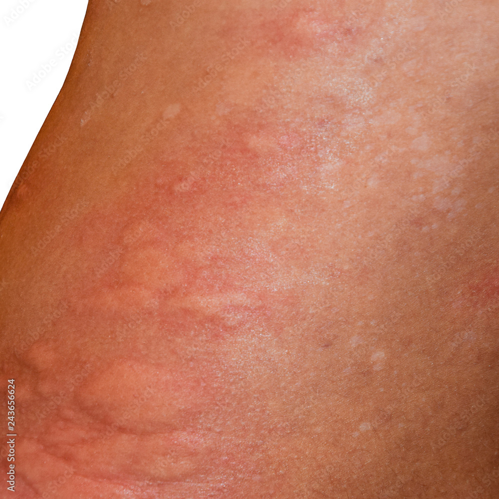 Fototapeta premium Allergy skin back and sides. Allergic reactions on the skin in t