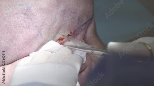 Surgeon cuts the tissues of the head with surgical scissors macro (4K, 25fps) photo