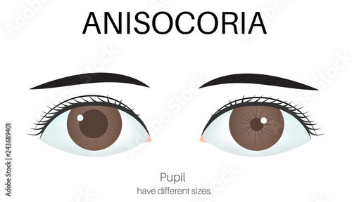 Image of eye with anisocoria