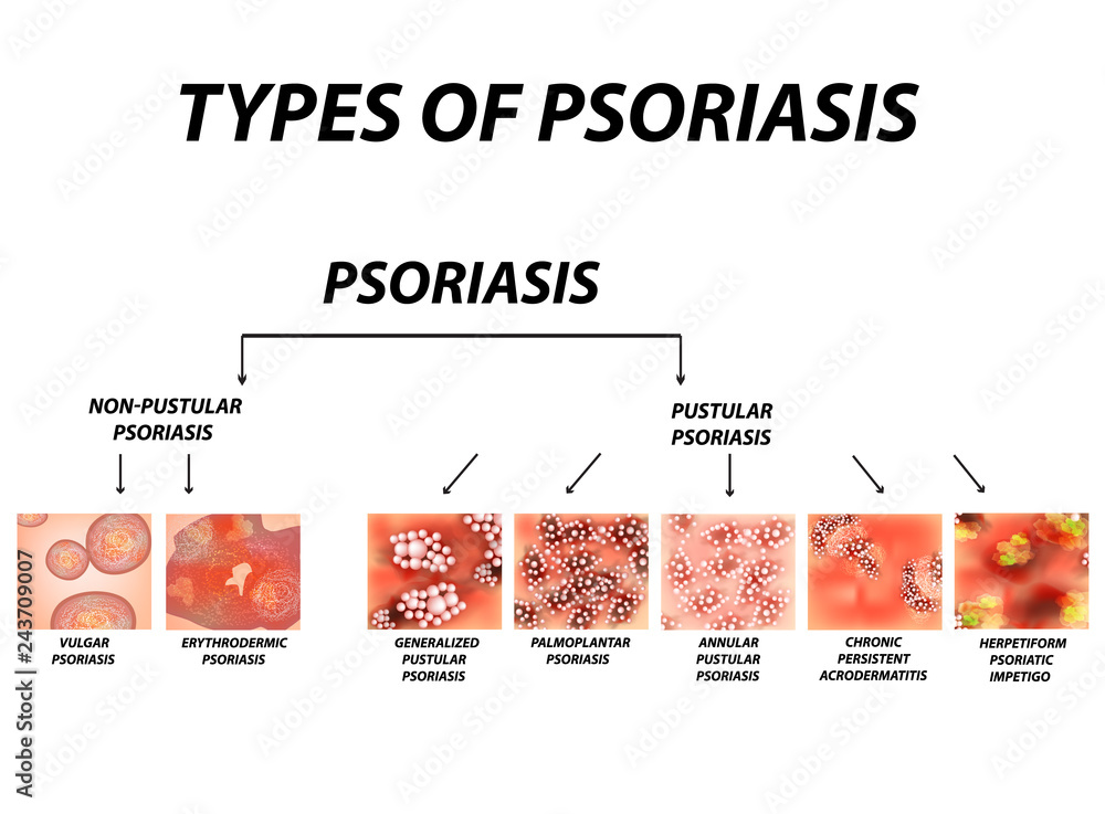 Types of psoriasis. Pustular and not pustular. Vulgar, erythroderma