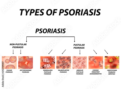 Types of psoriasis. Pustular and not pustular. Vulgar, erythroderma, erythrodermic psoriasis, persistent acrodermatitis, psoriatic impetigo. Eczema, skin disease dermatitis. Infographics. Vector