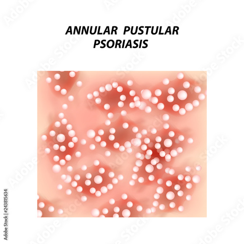 Annular pustular psoriasis. Eczema, dermatitis skin disease psoriasis. Infographics. Vector illustration on isolated background.
