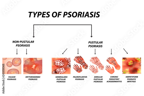 Types of psoriasis. Pustular and not pustular. Vulgar, erythroderma, erythrodermic psoriasis, persistent acrodermatitis, psoriatic impetigo. Eczema, skin disease dermatitis. Infographics. Vector