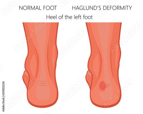 Vector illustration of the foot with normal heel and the  foot with Haglund's deformity and bursitis. For medical publications