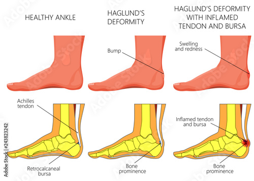 Illustration of an ankle (side view) with Haglund's deformity, inflamed Achilles tendon and bursitis.  For medical publications