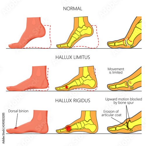 Illustration (diagram) of normal function, limited motion and rigid deformity (with degenerative arthritis) of the first metatarsophalangeal joint of the foot