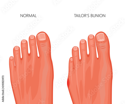 Illustration of the tailor's bunion of the human foot
