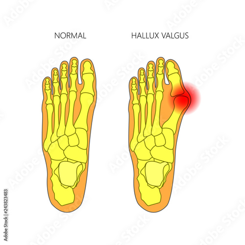 Illustration of the normal foot and valgus deviation of the first toe.