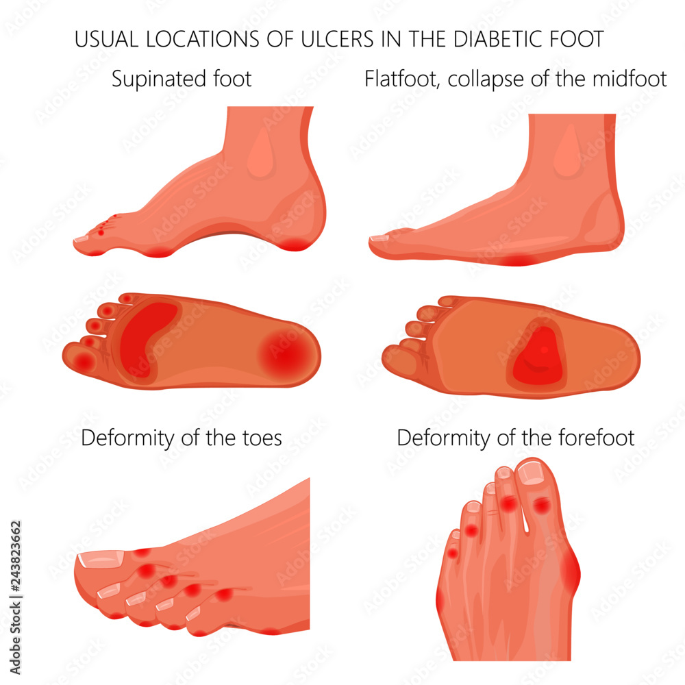 Illustration of usual locations of ulcers in the diabetic foot ...