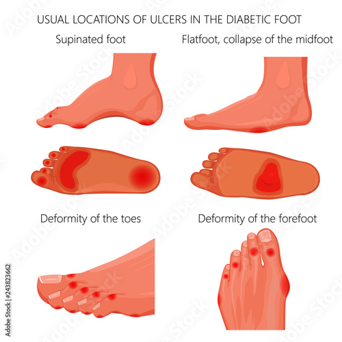 Illustration of usual locations of ulcers in the diabetic foot
