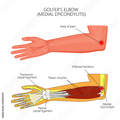 Illustration of Medial Epicondylitis or golfer's elbow.  Used: Gradient, transparency, blend mode. For medical publications.