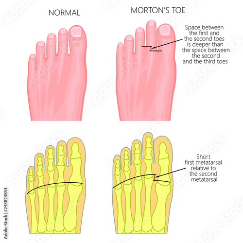 Vector illustration of foot - normal and with Morton's toe or Morton's Foot Syndrome, short first metatarsal bone relative to the second metatarsal. Top view of forefoot and  and skeleton of forefoot.